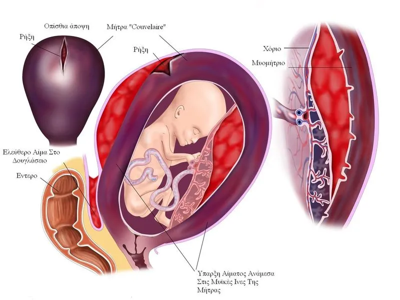 Что такое плацента. Плацента – во время беременности и после родов: что нужно знать Что значит низкая плацентация при беременности