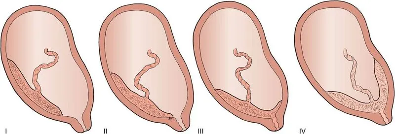 Почему возникает гематома в матке при беременности? Гематома при беременности на ранних сроках – признаки и лечение Гематома при беременности сильное кровотечение