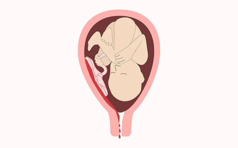 Беременность 12 недель идет кровь. Кровотечение при беременности на ранних и поздних сроках. Отношение к сексу