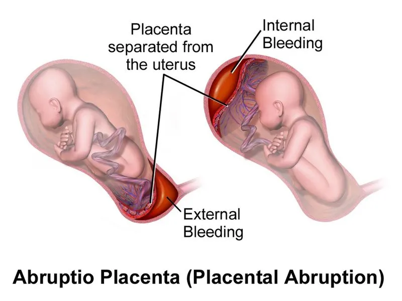 Раннее созревание плаценты. Преждевременное старение плаценты: причины, симптомы, лечение Почему плацента не стареет
